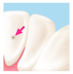 歯に黒い点があるのは？