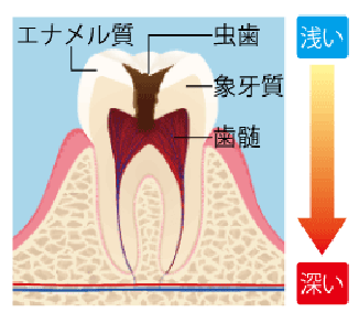 進行度別(C0〜C4)の目安