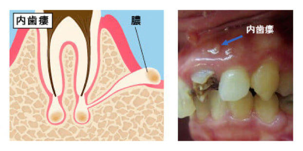 内歯瘻（ないしろう）