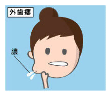 外歯瘻（がいしろう）