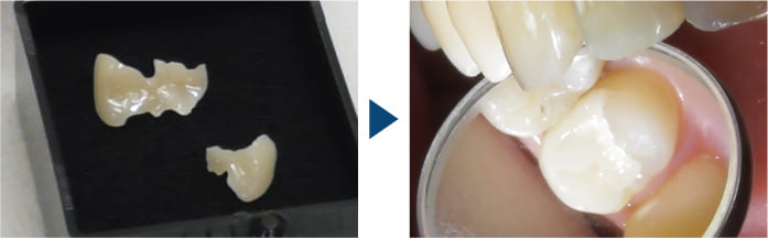 実際に装着したインレー