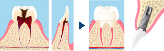 クラウン/抜歯（インプラント・ブリッジ・入れ歯）