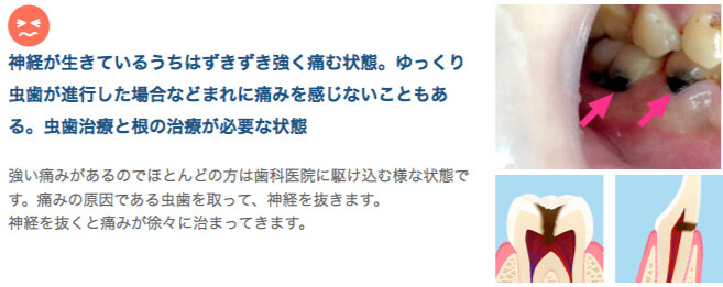 神経が生きているうちはずきずき強く痛む状態。