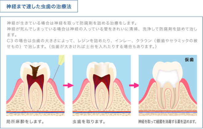 神経まで達した虫歯の治療法