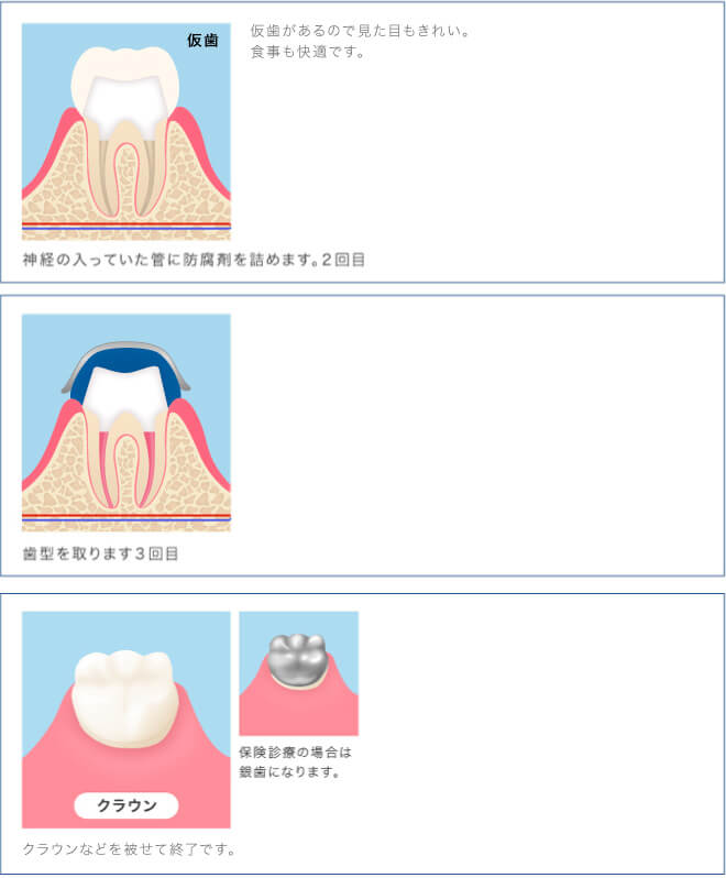 仮歯があるので見た目も綺麗。