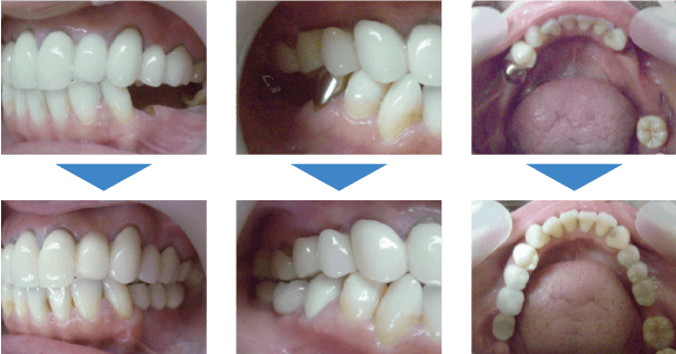 インプラント治療写真