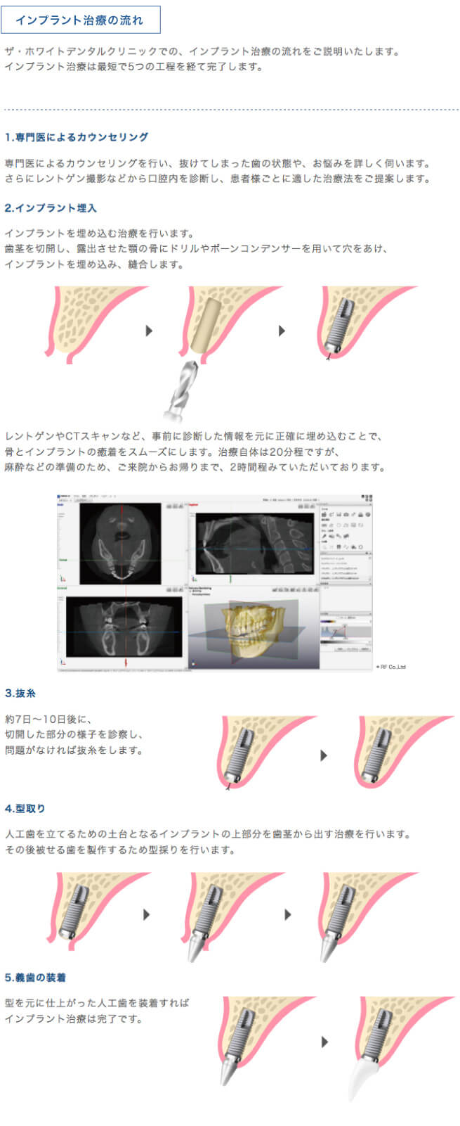 インプラント流れ