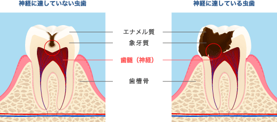 神経に達していない達している比較