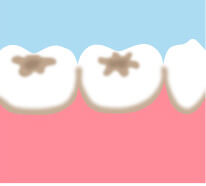 奥歯で注意する部分のイメージ