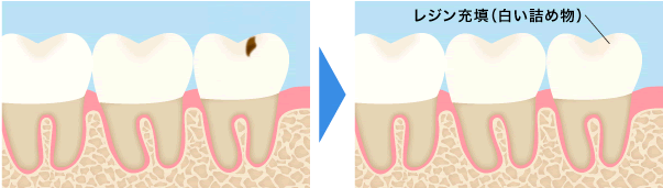 レジン充填(白い詰め物)