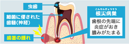 虫歯による歯茎の腫れの原因は根の先の病巣