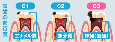 虫歯がC3まで進行してしまい、菌が神経まで達している状態。