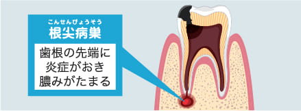 神経が死んでしまうと、根の先に膿が溜まっていきます。（根尖病巣）