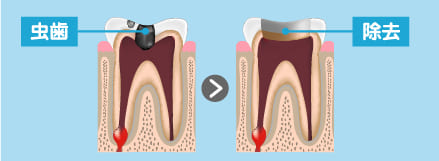 虫歯を除去