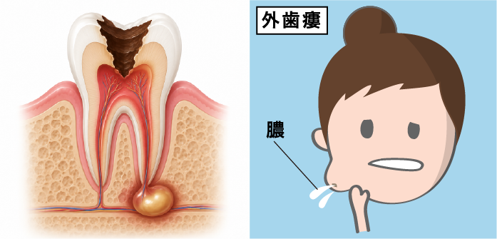 外歯瘻（がいしろう）