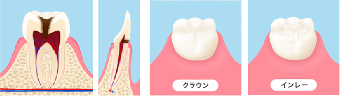 進行した虫歯（大きい虫歯）の場合