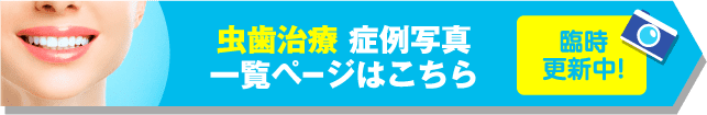 虫歯 症例写真一覧ページはこちら