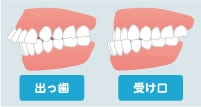 出っ歯・受け口