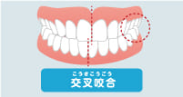 交叉咬合(こうさこうごう)