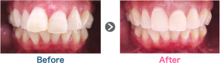 出っ歯が気になる方に
