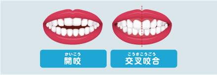 不正咬合の種類について