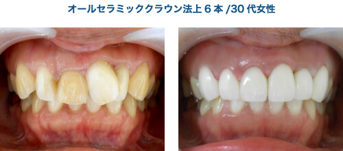 オールセラミッククラウン法上6本／30代女性