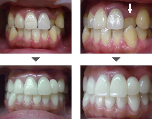 下の歯症例写真2