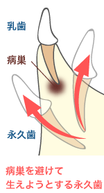 病巣を避けて生えようとする永久歯