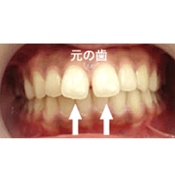 差し歯の場合