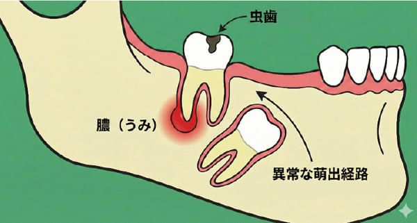 乳歯の虫歯が永久歯の生え方に影響を与える仕組みの図解