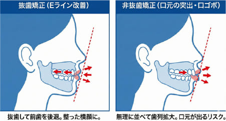 抜歯矯正と非抜歯矯正による口元の突出感(Eライン)の変化イメージ比較図