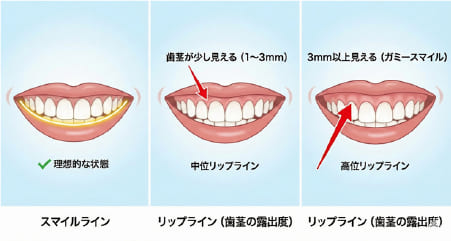 笑顔の印象を決めるスマイルライン（歯の先端のライン）とリップライン（歯茎の露出度）の解説イラスト