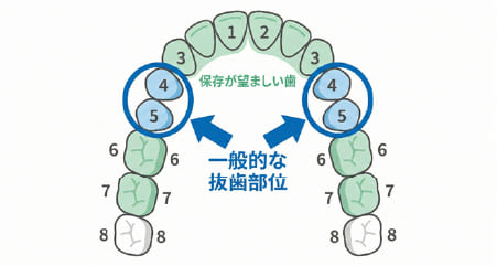 矯正治療で一般的に抜歯対象となる小臼歯(前から4〜5番目)の位置を示す歯列図