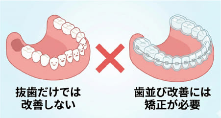 親知らずの抜歯と歯並び改善の誤解(抜歯だけでは歯並びは治らない)を示す図解イラスト