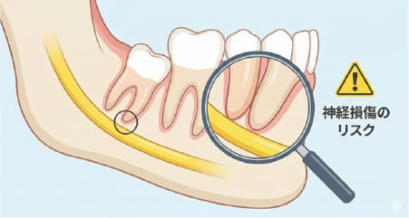 下顎の親知らずの抜歯における神経損傷リスクと、神経の位置関係を示す解剖図イラスト