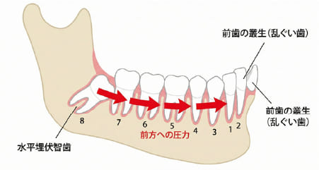 横向きの親知らずが手前の歯を押し、前歯のガタガタ(叢生)の原因になるメカニズムの図解