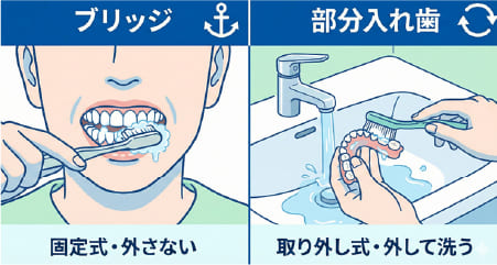 歯を失った時の3つの治療法（インプラント、ブリッジ、入れ歯）の構造と特徴の比較図