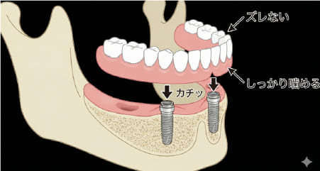 インプラントオーバーデンチャーの仕組み（インプラントで入れ歯を固定する安定性の高い方法）