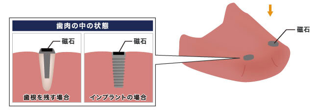 歯肉の中の状態