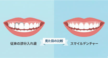 従来の部分入れ歯とスマイルデンチャー（ノンクラスプデンチャー）の見た目の比較。金属の留め金の有無による審美性の違い。