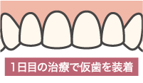 歯が原因のガミースマイル治療