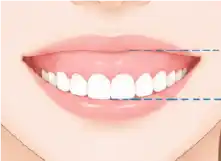 歯の生えている位置が低い、または歯が短い