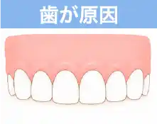 歯が原因