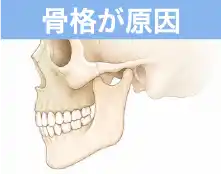 骨格が原因