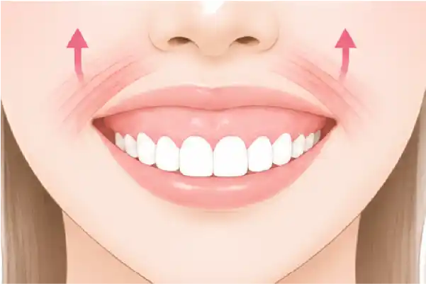 上唇を引き上げる筋肉の働きが強いことが原因