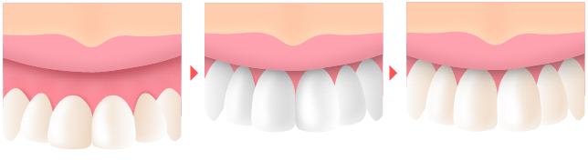 歯冠長延長術による歯茎の整形