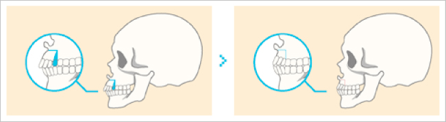 骨切り手術を行います