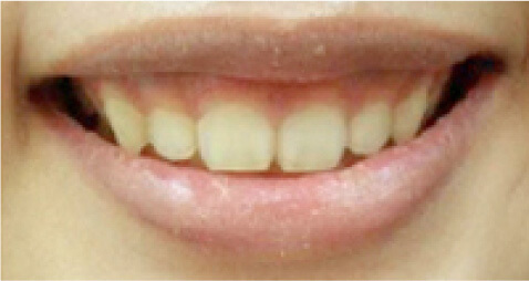 上唇を上げる筋肉の力が強い