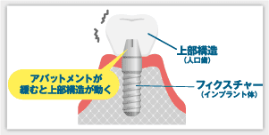 アバットメントの緩み