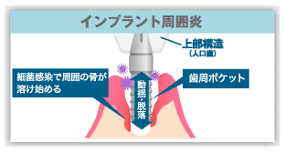 インプラント周囲炎